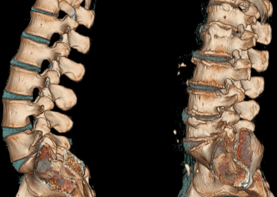 oseochondosis