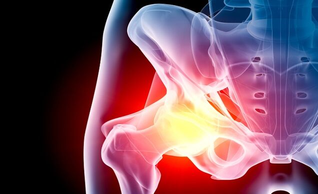 arthrosis tina sendi hip