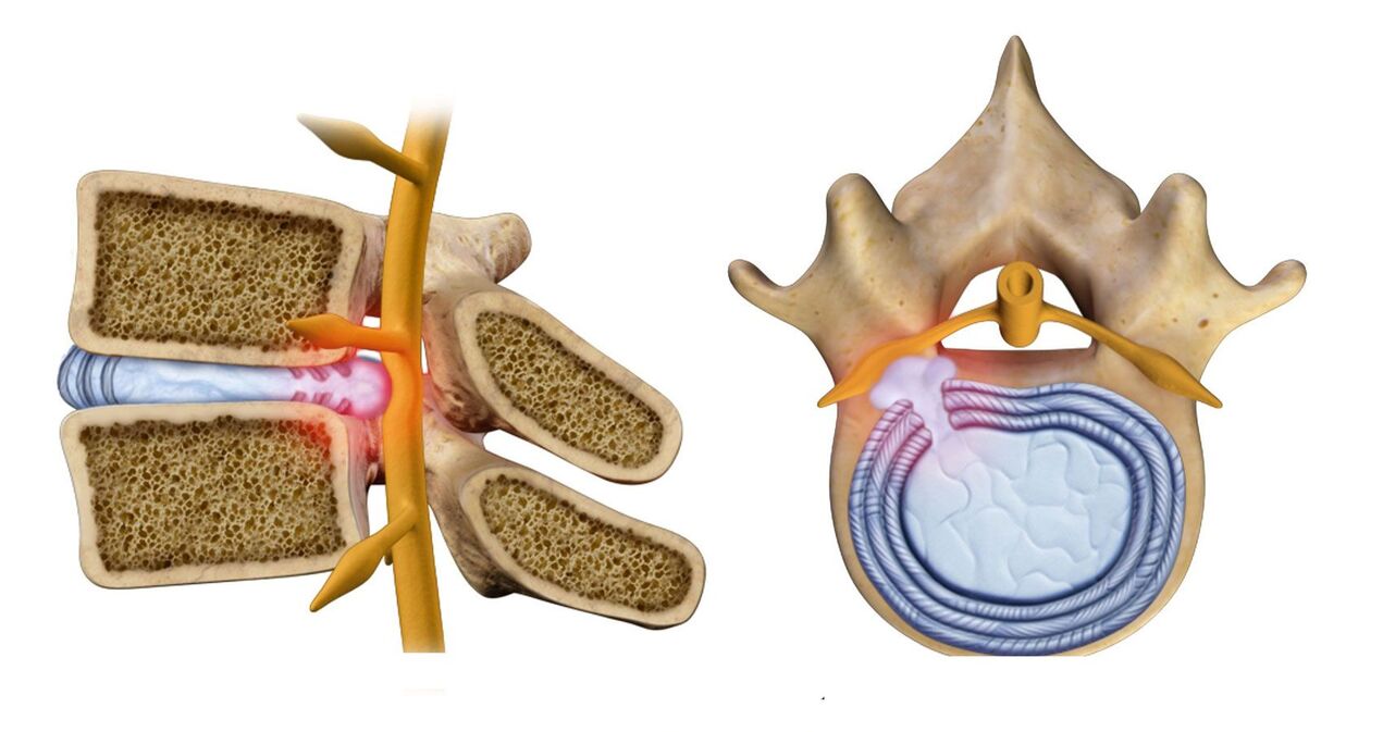 burut tulang tonggong dina osteochondrosis thoracic