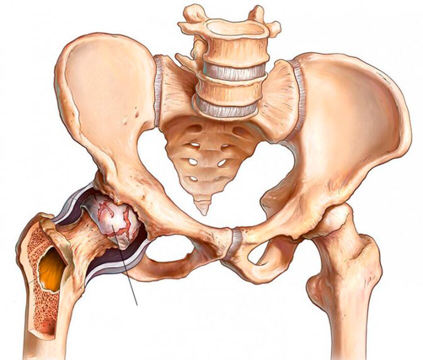 Arthrosis tina gabungan hip