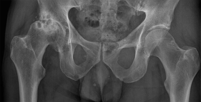 Deforming arthrosis tina gabungan hip on x-ray