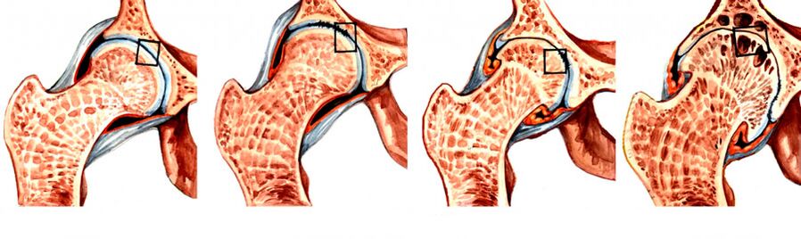 Tingkat ngembangkeun coxarthrosis tina gabungan hip