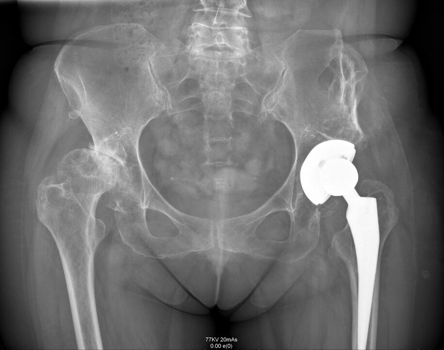 X-ray tina gabungan hip sanggeus arthroplasty