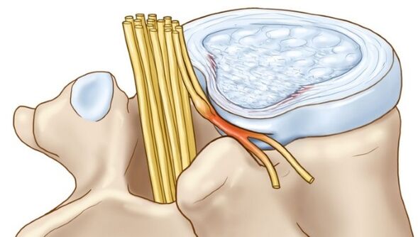 Osteochondrosis lumbar tiasa ngakibatkeun komplikasi dina bentuk burut intervertebral