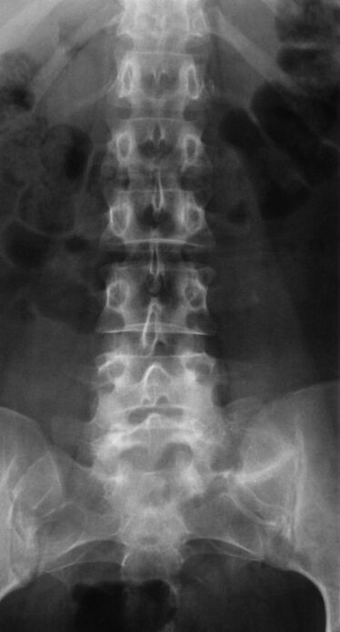Pikeun mendiagnosis osteochondrosis lumbar, radiografi dilaksanakeun