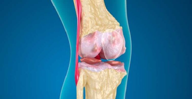 arthris panyakit grauch, anu nyababkeun karusakan tulang rawan dina sendi