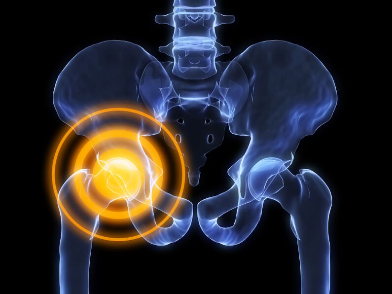 arthrosis tina sendi hip