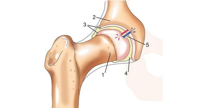 sendi hip jeung arthrosis